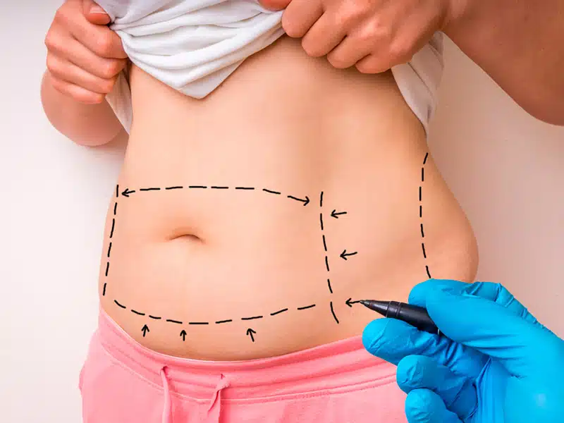 Full Tummy Tuck Wisconsin, Eau Claire