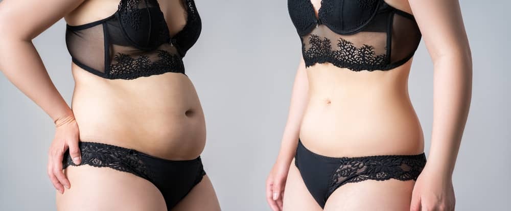 Tummy tuck is different from liposuction because it tightens the muscles in addition to removing extra fat