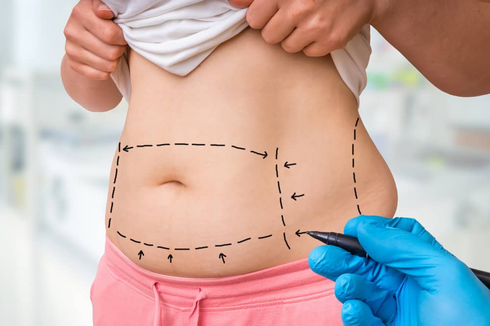 You can discuss with your plastic surgeon what type of tummy tuck is the best for you