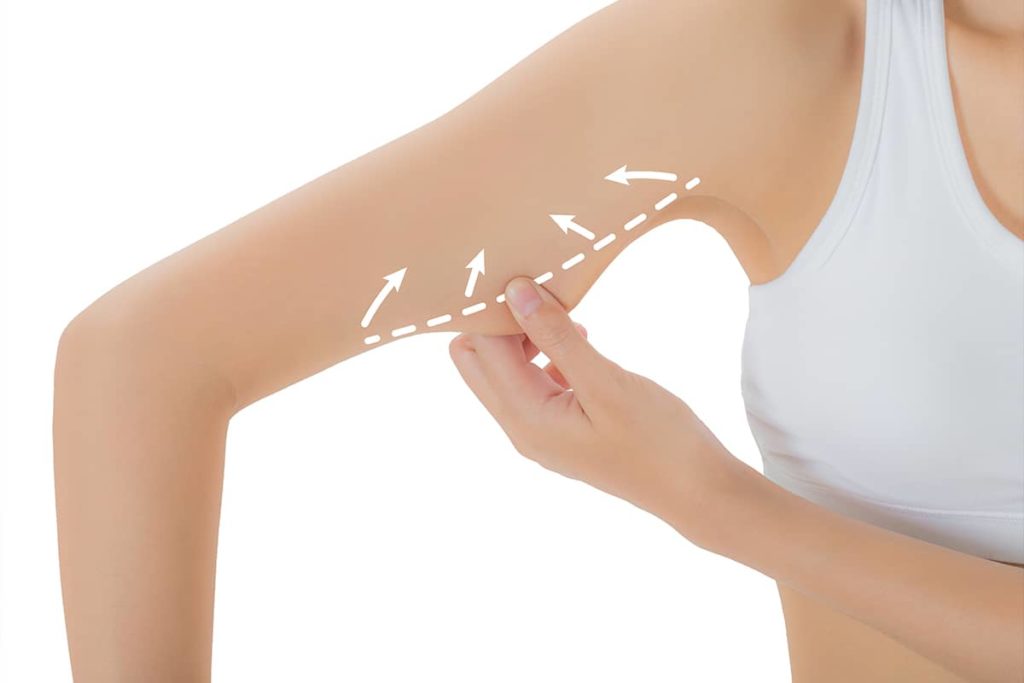 Fat cells in the upper arms are often resistant to diet and exercise, making liposuction a popular treatment for this area.