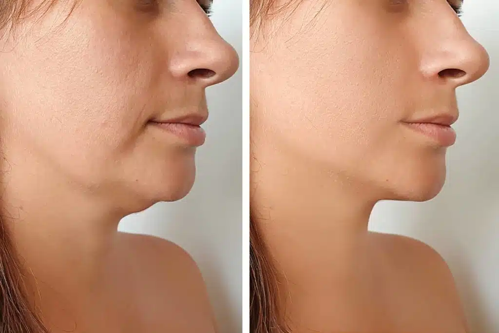 Depending on the amount of skin laxity, chin liposuction might need to be coupled with a neck lift to achieve tighter skin