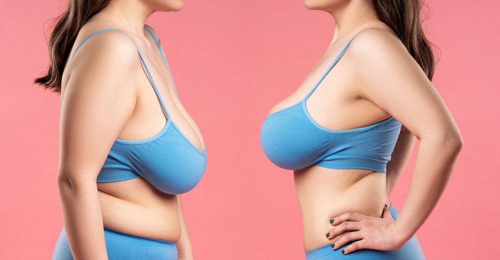 The Benefits of Breast Lift Surgery