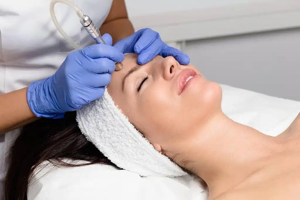 Microdermabrasion is a minimally invasive non-surgical procedure that exfoliates and polishes the skin to reduce the appearance of sun damage, brown spots, and other discoloration