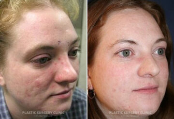 Acne Scarring Before and After Photos in Eau Claire, Wisconsin, Patient 171