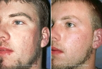 Acne Scarring Before and After Photos in Eau Claire, Wisconsin, Patient 177