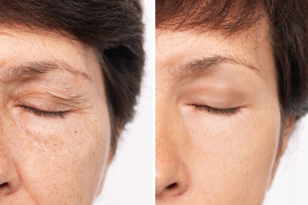 Before and after images showing the results of lower blepharoplasty, illustrating the removal of under-eye bags and a more youthful appearance.