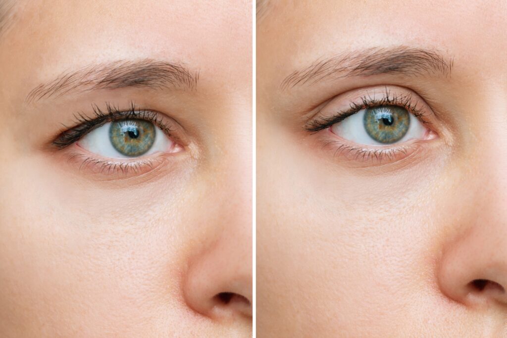 Strengthen your facial muscles with a Blepharoplasty, deal with loose extra skin produced by elasticity loss with Dr. Ember Ewings at Eau Claire, WI.