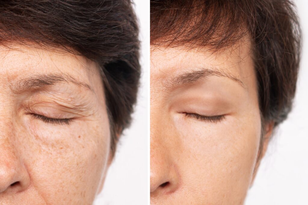 Blepharoplasty can help with extra skin from elasticity loss.