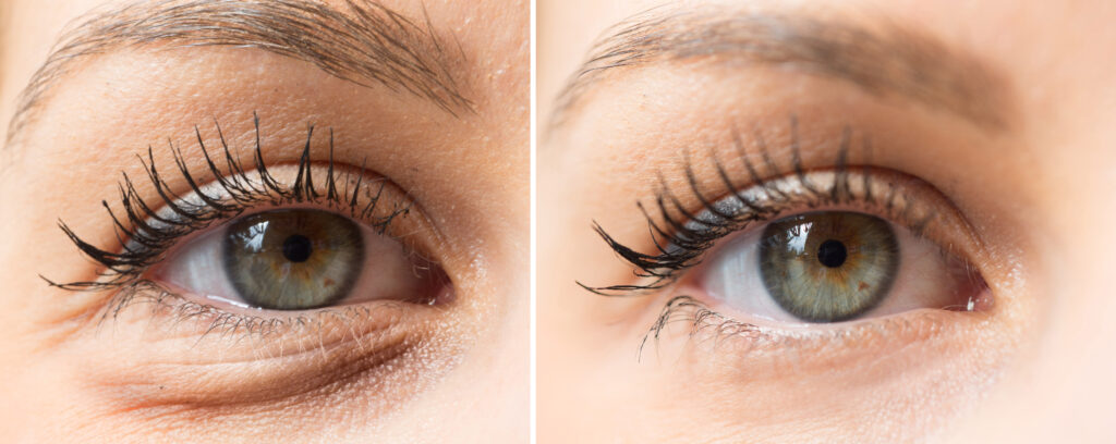 Deal with eyebags with a smooth procedure with Dr. Ember Ewings at Eau Claire, Wisconsin.