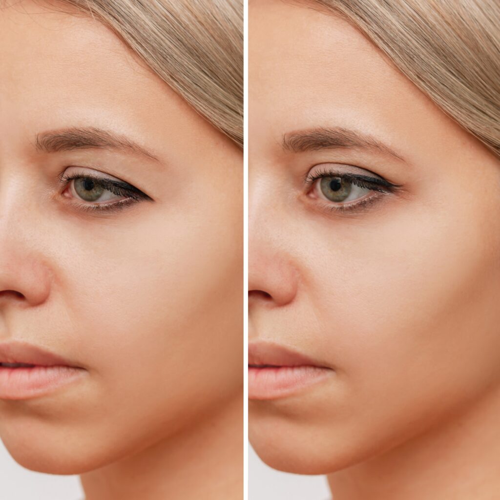 This eye rejuvenation treatment can deal with droopy eyelids or retraction, eliminating that tired appearance.
