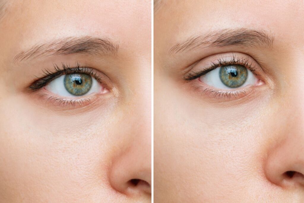 Before and after images showing the results of lower blepharoplasty, highlighting reduced dark circles and a rejuvenated eye area.