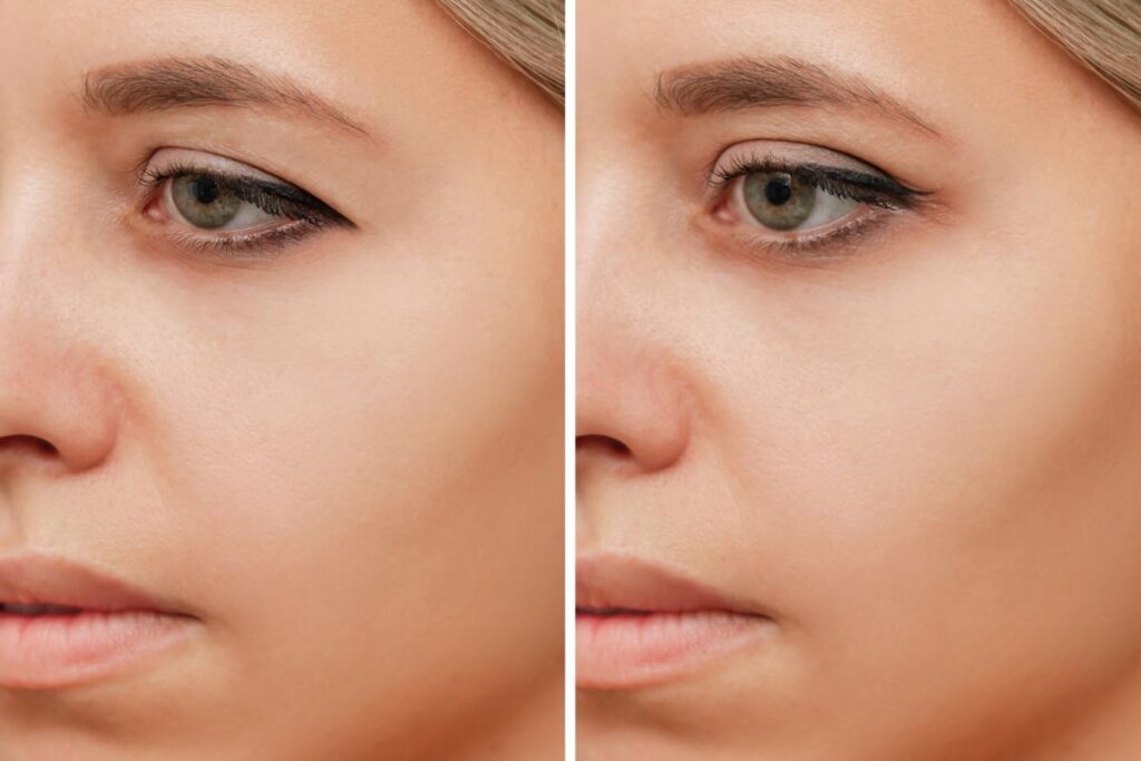 Before and after images showing the results of scarless lower blepharoplasty, highlighting a more youthful and vibrant eye appearance.