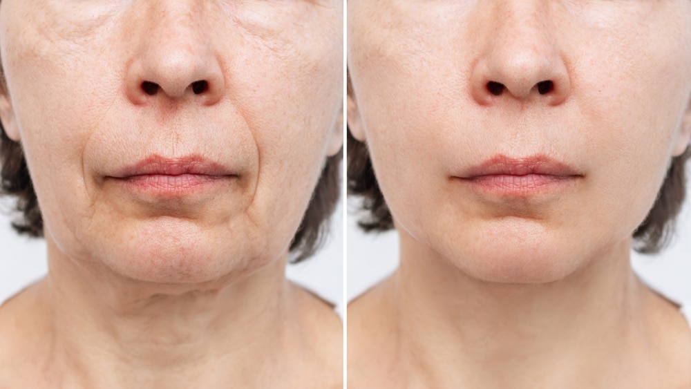 Natural remedies can be a great support during your facelift recovery period.