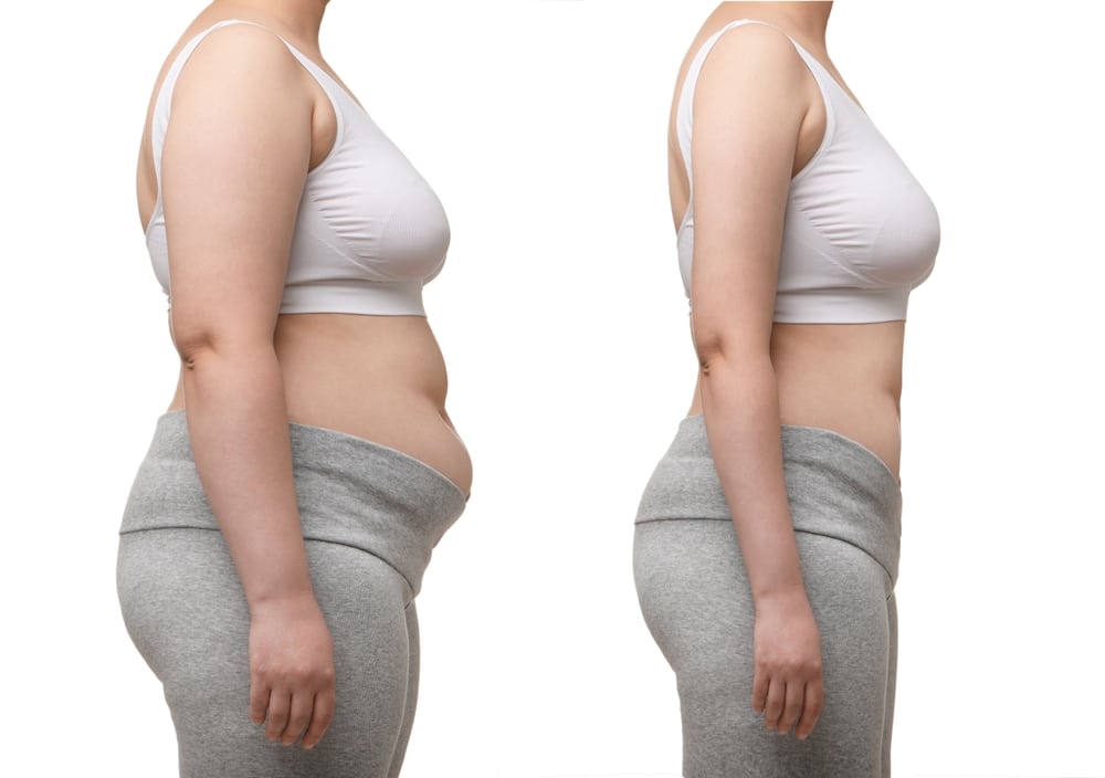 Side-by-side view of a woman before and after a mommy makeover showing reduced abdominal fat and improved contour.